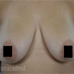 Breast Lift Before & After Patient #2290