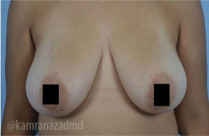 Breast Lift Before & After Patient #2290