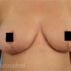 Breast Lift Before & After Patient #2290