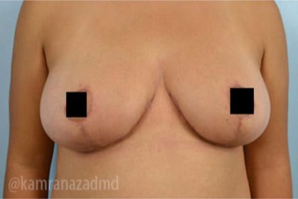 Breast Lift Before & After Patient #2290