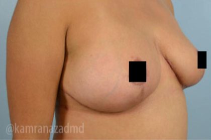 Breast Lift Before & After Patient #2290