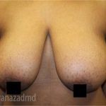 Breast Lift Before & After Patient #2291