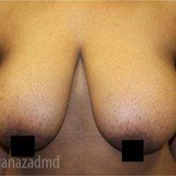 Breast Lift Before & After Patient #2291