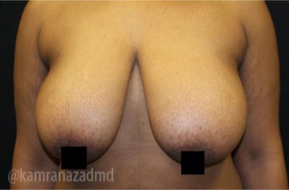 Breast Lift Before & After Patient #2291