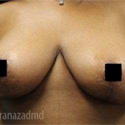 Breast Lift Before & After Patient #2291