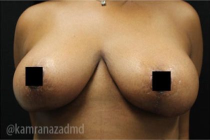 Breast Lift Before & After Patient #2291