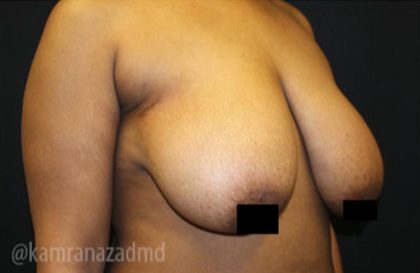 Breast Lift Before & After Patient #2291