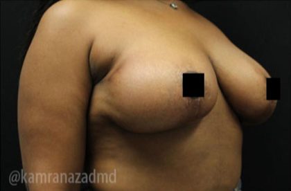 Breast Lift Before & After Patient #2291