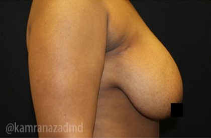 Breast Lift Before & After Patient #2291