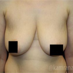 Breast Lift Before & After Patient #2292