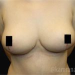 Breast Lift Before & After Patient #2292