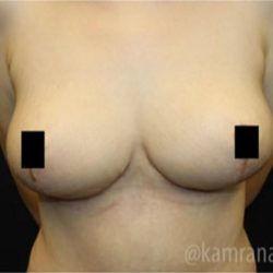 Breast Lift Before & After Patient #2292