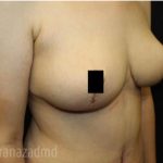 Breast Lift Before & After Patient #2292