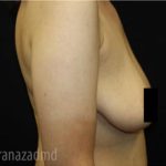 Breast Lift Before & After Patient #2292
