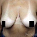 Breast Lift Before & After Patient #2293