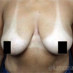 Breast Lift Before & After Patient #2293