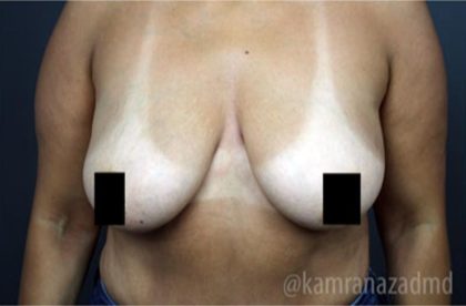 Breast Lift Before & After Patient #2293