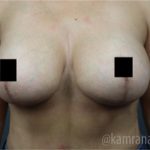 Breast Lift Before & After Patient #2293
