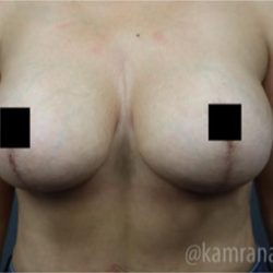Breast Lift Before & After Patient #2293