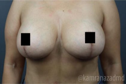 Breast Lift Before & After Patient #2293