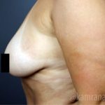 Breast Lift Before & After Patient #2293