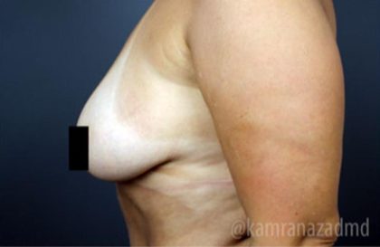 Breast Lift Before & After Patient #2293