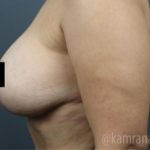 Breast Lift Before & After Patient #2293