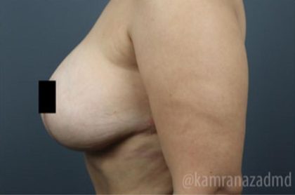 Breast Lift Before & After Patient #2293