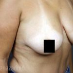 Breast Lift Before & After Patient #2293