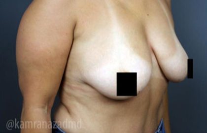 Breast Lift Before & After Patient #2293