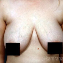 Breast Lift Before & After Patient #2294