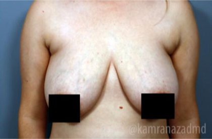 Breast Lift Before & After Patient #2294