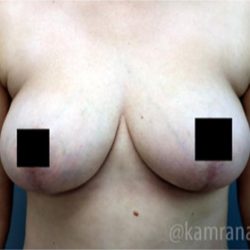 Breast Lift Before & After Patient #2294