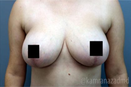 Breast Lift Before & After Patient #2294
