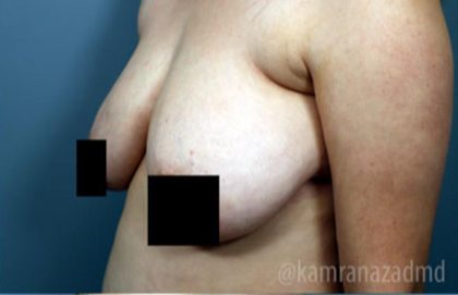 Breast Lift Before & After Patient #2294