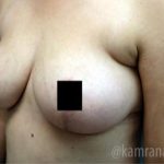 Breast Lift Before & After Patient #2294