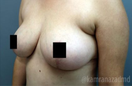 Breast Lift Before & After Patient #2294