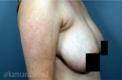 Breast Lift Before & After Patient #2294