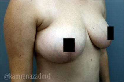 Breast Lift Before & After Patient #2294
