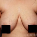 Breast Lift Before & After Patient #2295