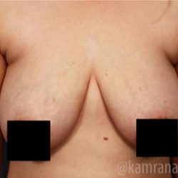 Breast Lift Before & After Patient #2295