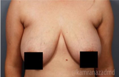 Breast Lift Before & After Patient #2295