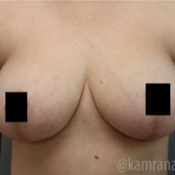 Breast Lift Before & After Patient #2295