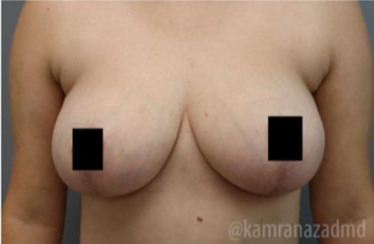 Breast Lift Before & After Patient #2295