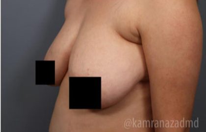 Breast Lift Before & After Patient #2295