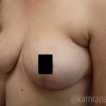Breast Lift Before & After Patient #2295