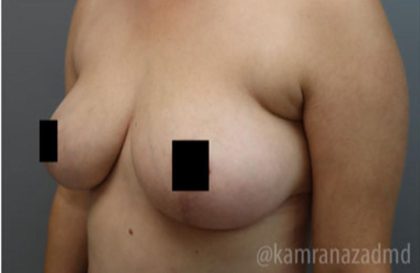 Breast Lift Before & After Patient #2295