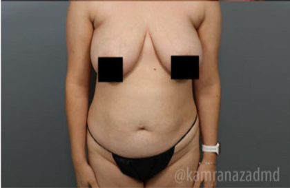 Breast Lift Before & After Patient #2295
