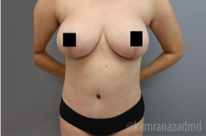 Breast Lift Before & After Patient #2295