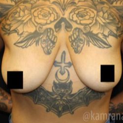 Breast Lift Before & After Patient #2296